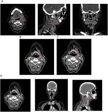 lymphoma radiation oncology group