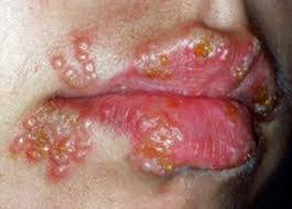Image result for herpes