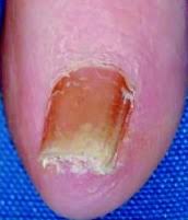 common nail disorders refhelp