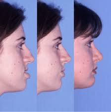 corrective and orthognathic jaw surgery