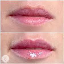 botox and filler treatment lips