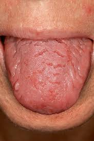 Pickel auf der zunge können eine ganze reihe von ursachen haben. Die Zunge Normvarianten Und Pathologische Veranderungen Quintessenz Verlags Gmbh
