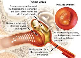 Otitis Media Is An Inflammation Of The Middle Ear Acute