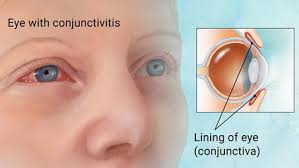 pink eye conjunctivitis first eye