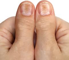 causes ridges splitting on your nails