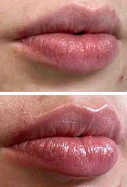 all about microneedling lips why it s