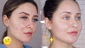 acne scars dark spots