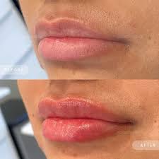 how much is lip filler
