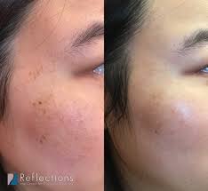 sebaceous hyperplasia before after