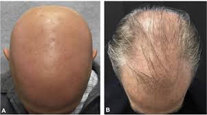 There are many types of alopecia areata affects any part of the body, including the scalp. At The Crossroads Of 2 Alopecias Androgenetic Alopecia Pattern Of Hair Regrowth In Patients With Alopecia Areata Treated With Oral Janus Kinase Inhibitors Jaad Case Reports