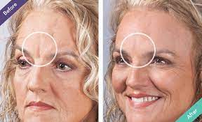 wrinkle fillers an alternative to
