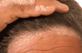 psoriasis of scalp dr aditis advanced