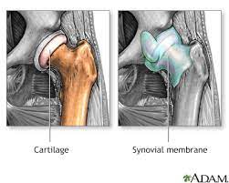 hip joint replacement information