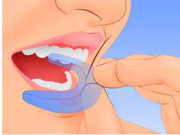如何治疗被咬伤的舌头（包含图片）