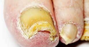 toenail fungus treatments when to see