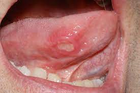 recur aphthous ulcer located on the