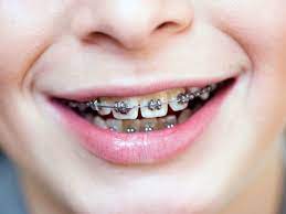 At the end of your child's treatment, they will have a new found confidence and a bright new smile to last a lifetime. Do Braces Hurt What To Expect When You Get Braces