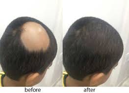 alopecia areata know the symptoms