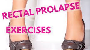 rectal prolapse exercises to reduce the