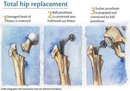faqs for hip replacement