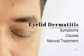 eyelid dermais eczema symptoms