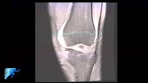 al meniscus tear knee specialist