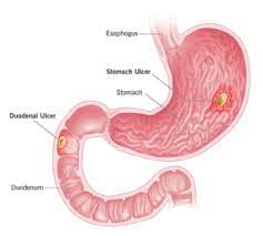 ulcers after gastric byp surgery