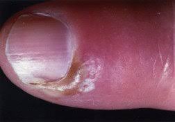 paronychia guide causes symptoms and