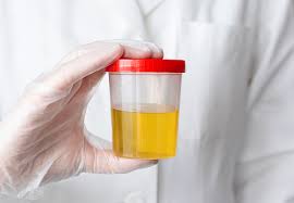 The Doctor Holds A Can Of Urine Analysis In His Hand Urine Sample For Exam  Selective Focus Stock Photo - Download Image Now - iStock
