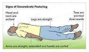 posturing after brain injury explained