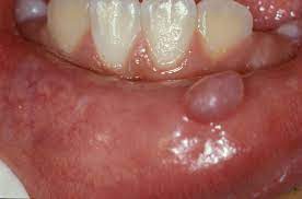 mucocele causes symptoms