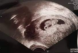 Mein erstes baby, ultraschall in der 19 ssw und es wird ein junge. Ultraschallbilder Mehr Als 50 Bilder Aus Der Schwangerschaft Faminino