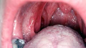 thrush and hiv symptoms causes