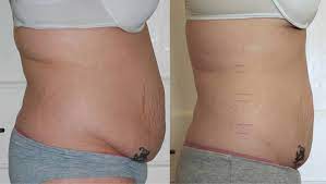 non surgical laser lipo fat reduction