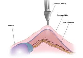 Vasectomy represents a surgical procedure for male sterilization. No Scalpel No Needle Vasectomy La Plata Urological