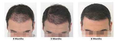 The remaining donor area's hair begins to grow immediately after the transplant and covers the area in a week. Growth Of Hair After Fue Maral Hair