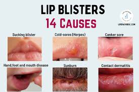 blister on lip cold sores and 13 other