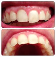 What causes gaps between the teeth? Blog Posts A Straighter Smile Take Two