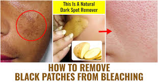 black patches from bleaching