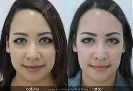 If you have been on a look out to look young and scouring the internet, then definitely you would have definitely come across dermal fillers. Facial Reshaping And Facial Slimming Facelove