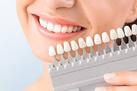 teeth whitening keynsham dental care