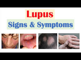 lupus signs symptoms why they