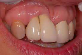 triangle of gums between teeth and implants