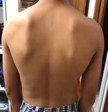 The bones of the back, together, make up the vertebral column. How Do I Get Rid Of Bones That Stick Out On My Upper Back Posturetipsguide