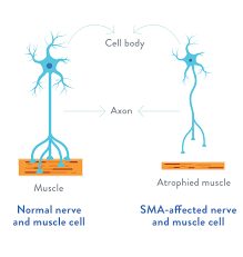 what is sma spinal muscular atrophy
