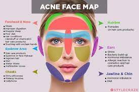 where your acne appears matters