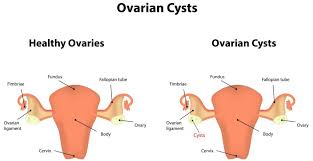 ovarian cysts are they dangerous