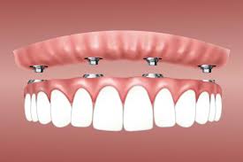 dental implant procedure what you need