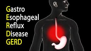 gerd gastroesophageal reflux disease