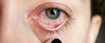 read insights about red bloodshot eyes